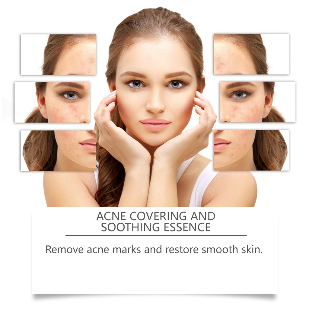 Acne Soothing Serum Facial Skin Hydrating And Moisturizing Pitted And Pimple Mild Care Solution